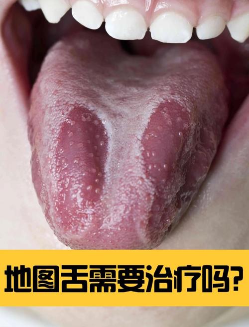 地图,地图舌