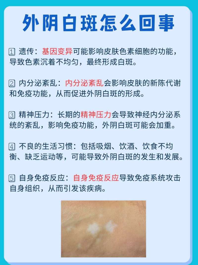 什么是妇科白斑有什么症状呢,妇科白斑病是一种什么病怎样治疗