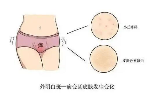 白斑病是妇科病吗,白斑病是妇科病吗严重吗