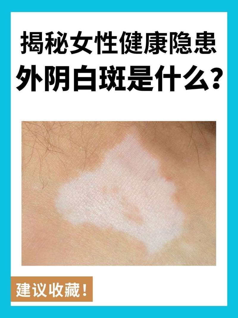 女性妇科白斑病是什么症状,女性妇科白斑病是什么症状引起的