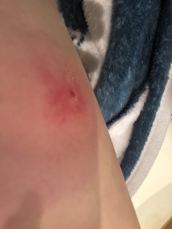 大腿根部很痒还有包-大腿根部很痒还有包怎么回事
