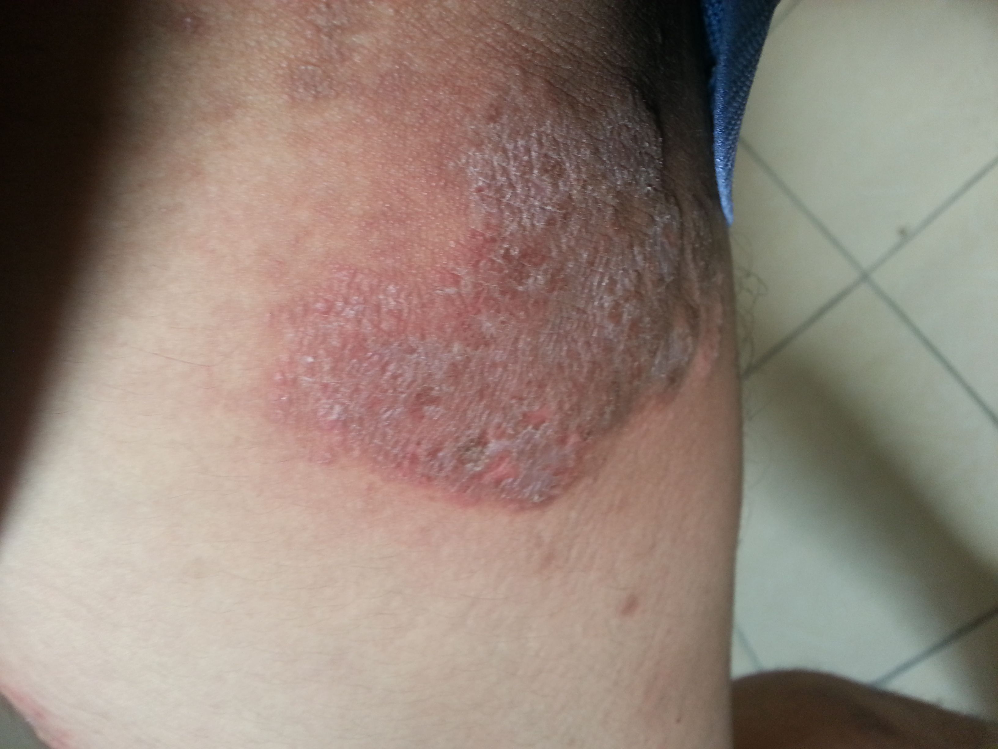 大腿根部很痒还有包-大腿根部很痒还有包怎么回事