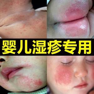 去除婴儿热疹小妙招-婴儿热疹和湿疹图片对比